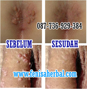 Illustration for article titled Cara Menyembuhkan Kutil Kelamin